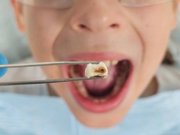 Best Emergency Treatment for Toothache in Butte, AK