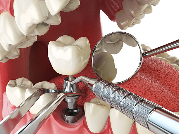 Best Emergency Tooth Extraction in Butte, AK