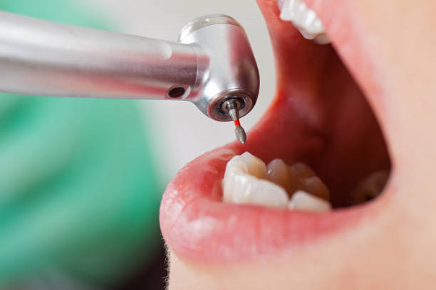 Best Emergency Treatment for Toothache in Butte, AK